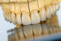dientes-de-cerámica-puente-dental-32679144