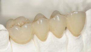 puente-dental-de-4-piezas