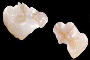 incrustaciones-zirconio-y-o-porcelana