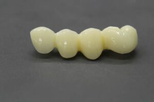 provisionales-pmma-protesis-dentales-milanes3